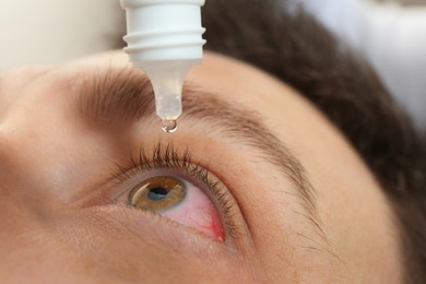 Man with conjunctivitis using eye drops, closeup