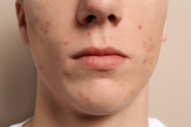 Photo of Teen guy with acne problem on beige background, closeup