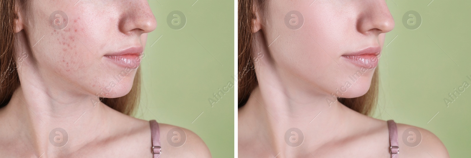 Image of Acne problem. Young woman before and after treatment on green background, closeup. Collage of photos