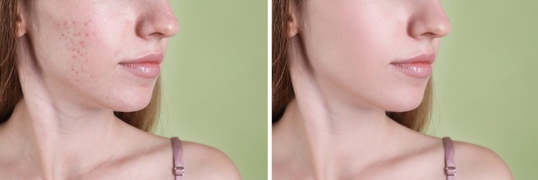 Acne problem. Young woman before and after treatment on green background, closeup. Collage of photos