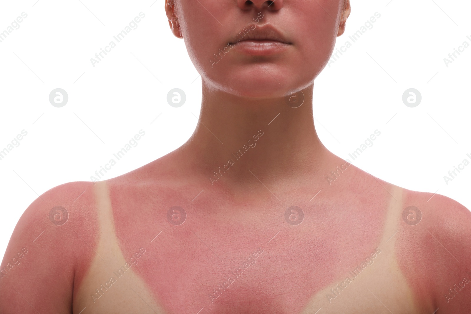 Photo of Woman with sunburned skin on white background, closeup