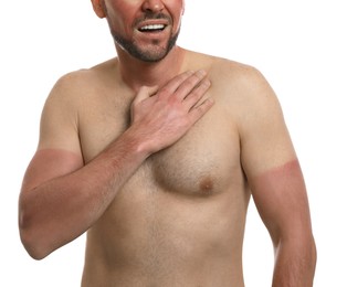 Man with sunburned skin on white background, closeup