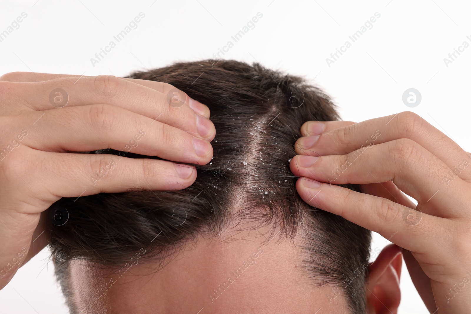 Photo of Man with dandruff in his dark hair on white background, closeup