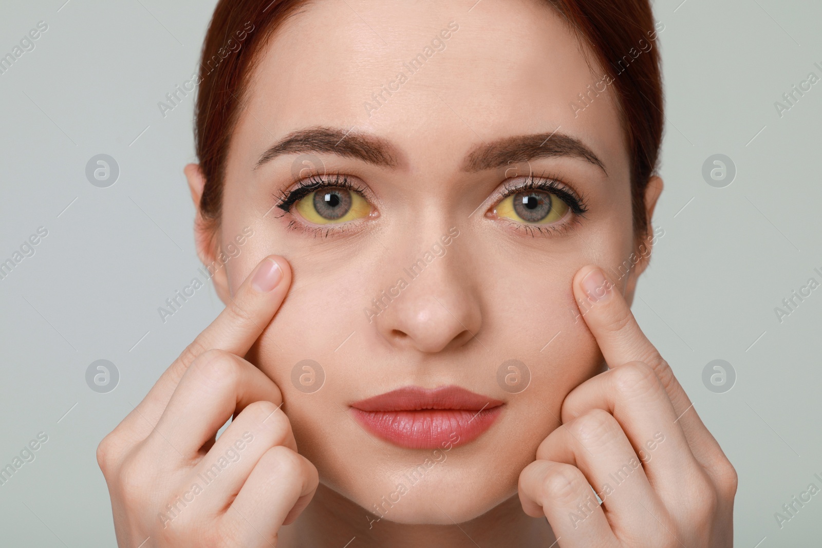 Photo of Woman with yellow eyes on light grey background. Symptom of hepatitis