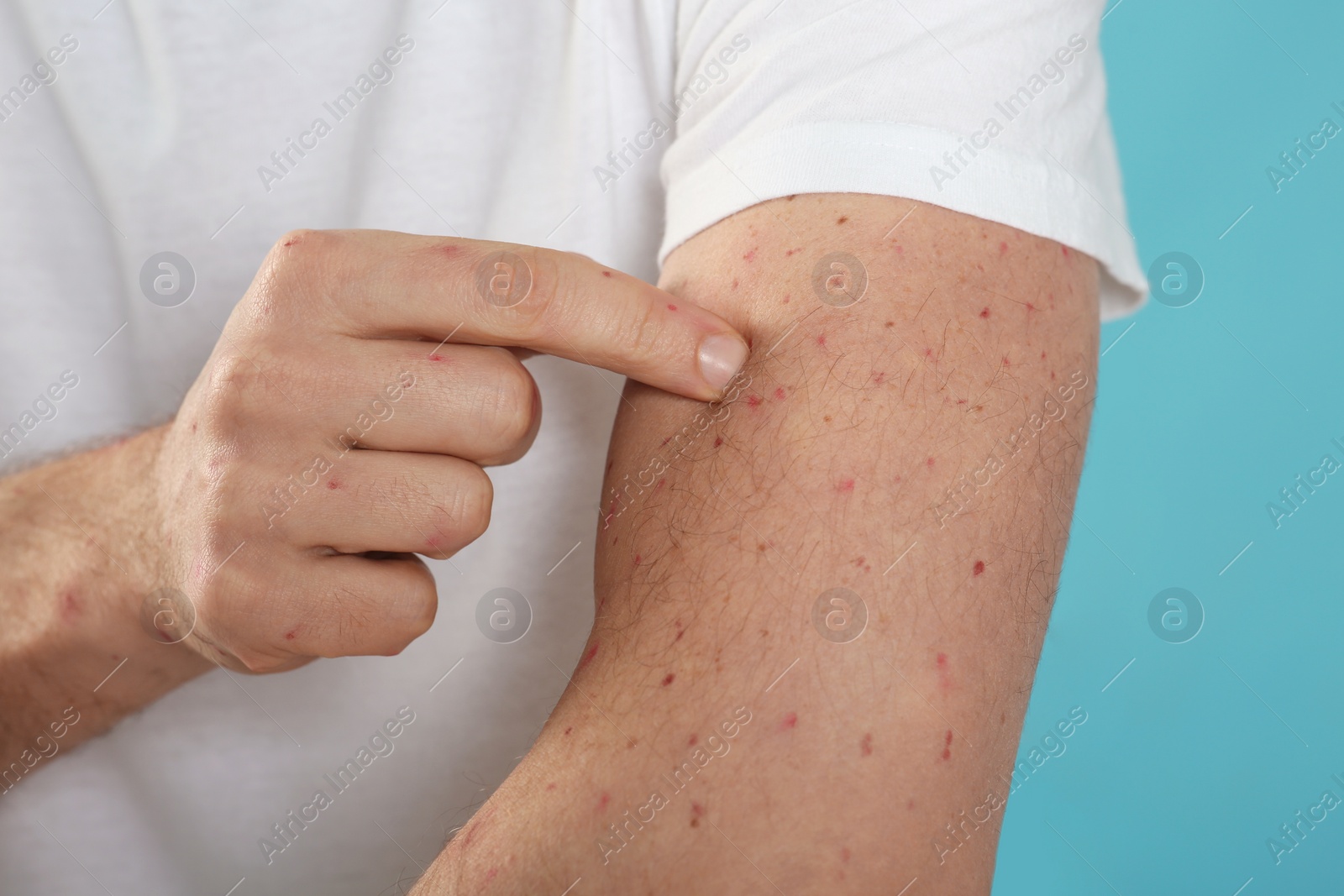 Photo of Man with rash suffering from monkeypox virus on light blue background, closeup