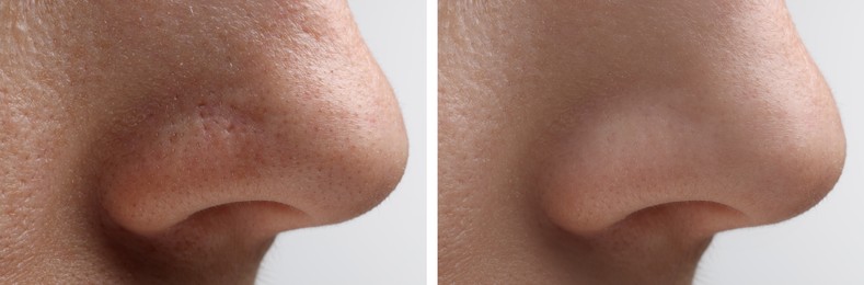 Image of Before and after acne treatment. Photos of woman on white background, closeup. Collage showing affected and healthy skin