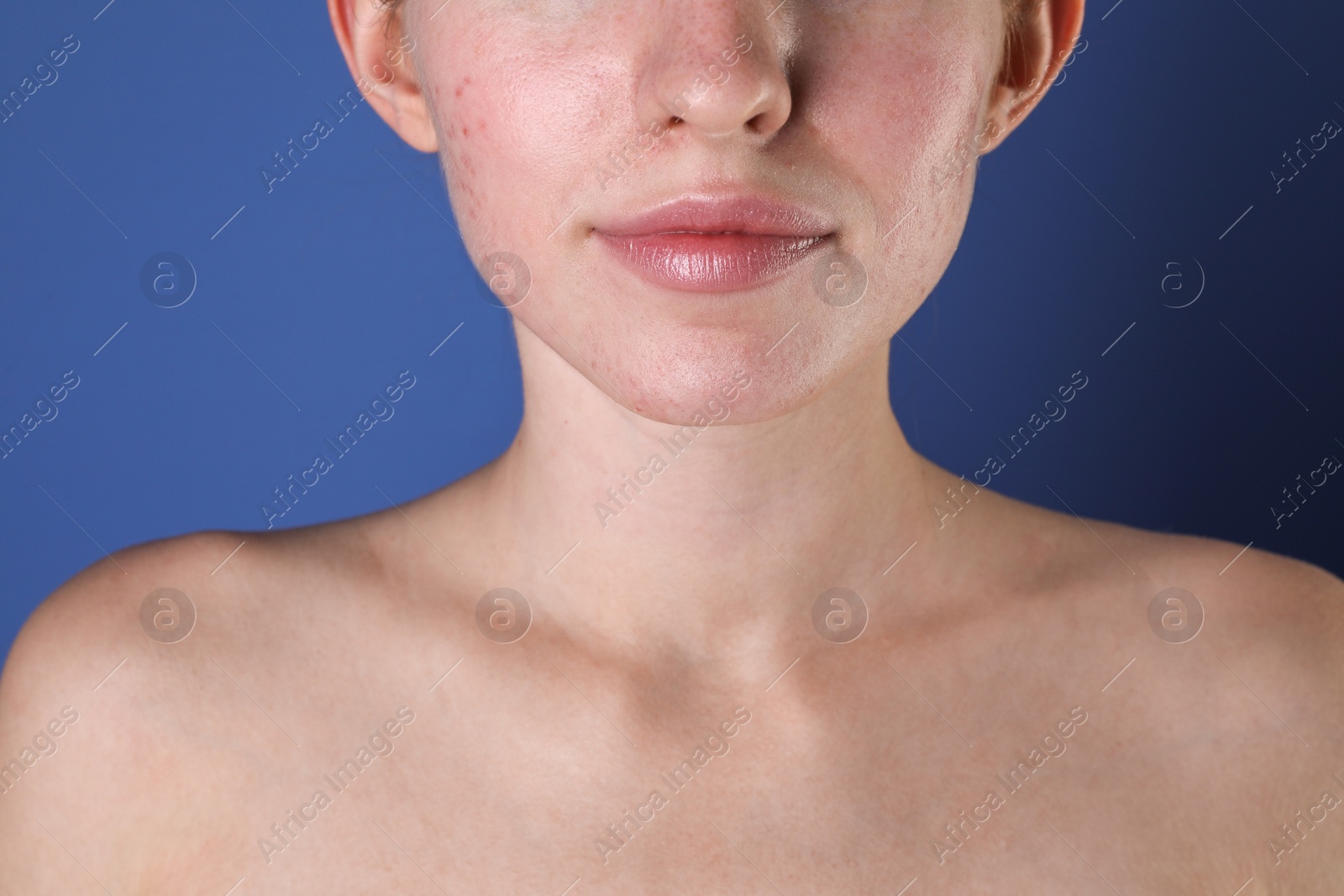 Photo of Young woman with acne problem on blue background, closeup