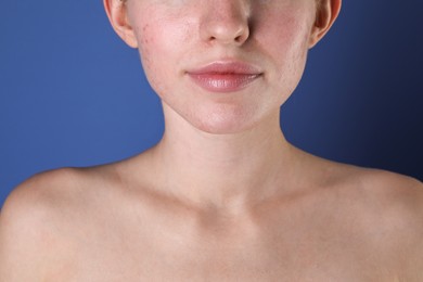 Young woman with acne problem on blue background, closeup