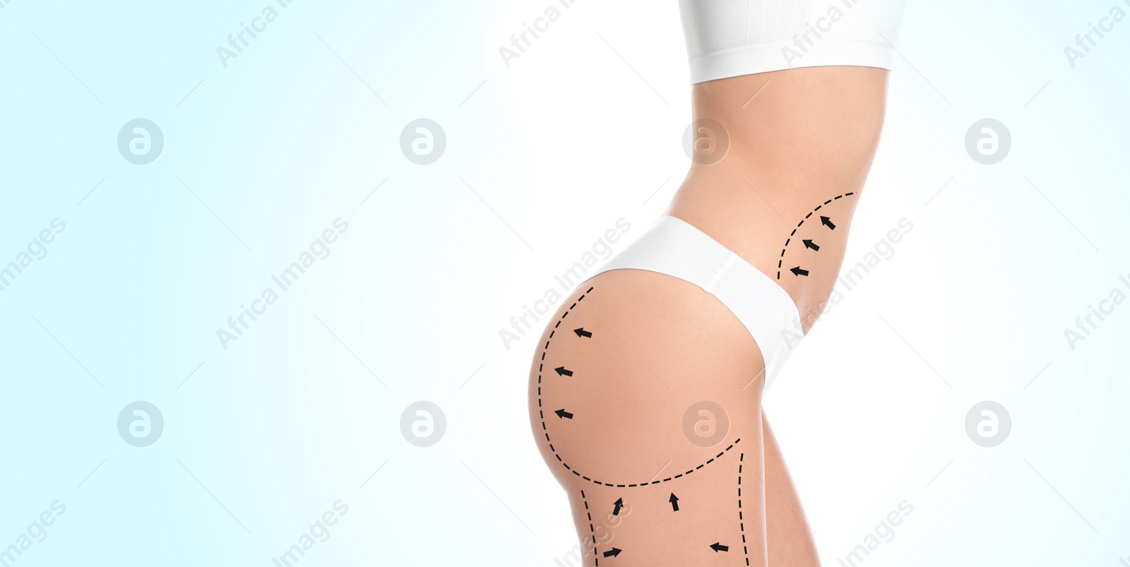 Image of Slim young woman with marks on body for cosmetic surgery operation against light background, closeup. Banner design