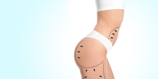 Image of Slim young woman with marks on body for cosmetic surgery operation against light background, closeup. Banner design