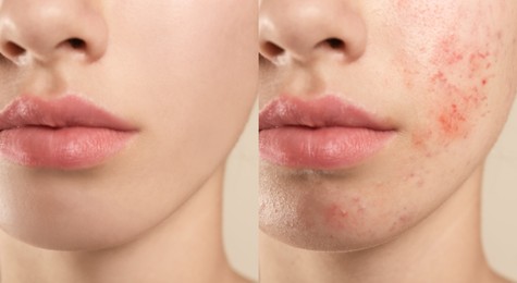 Image of Collage with photos of teenage girl with acne problem before and after treatment, closeup. Banner design