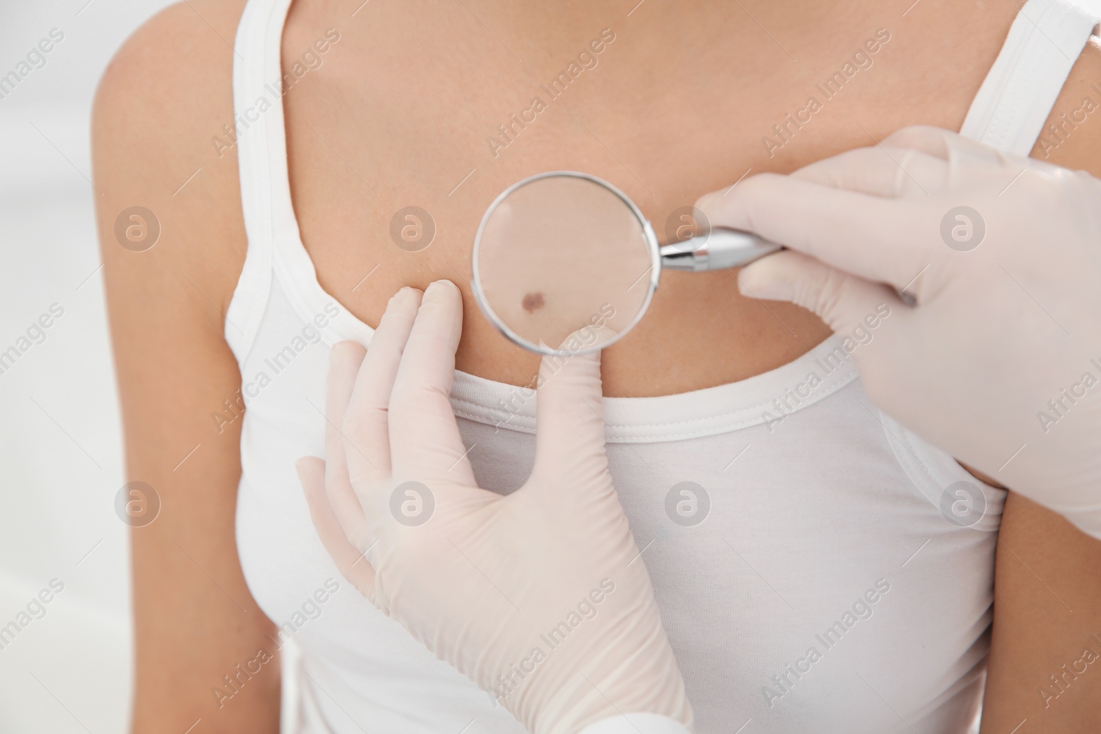 Photo of Dermatologist examining patient's birthmark with magnifying glass in clinic, closeup