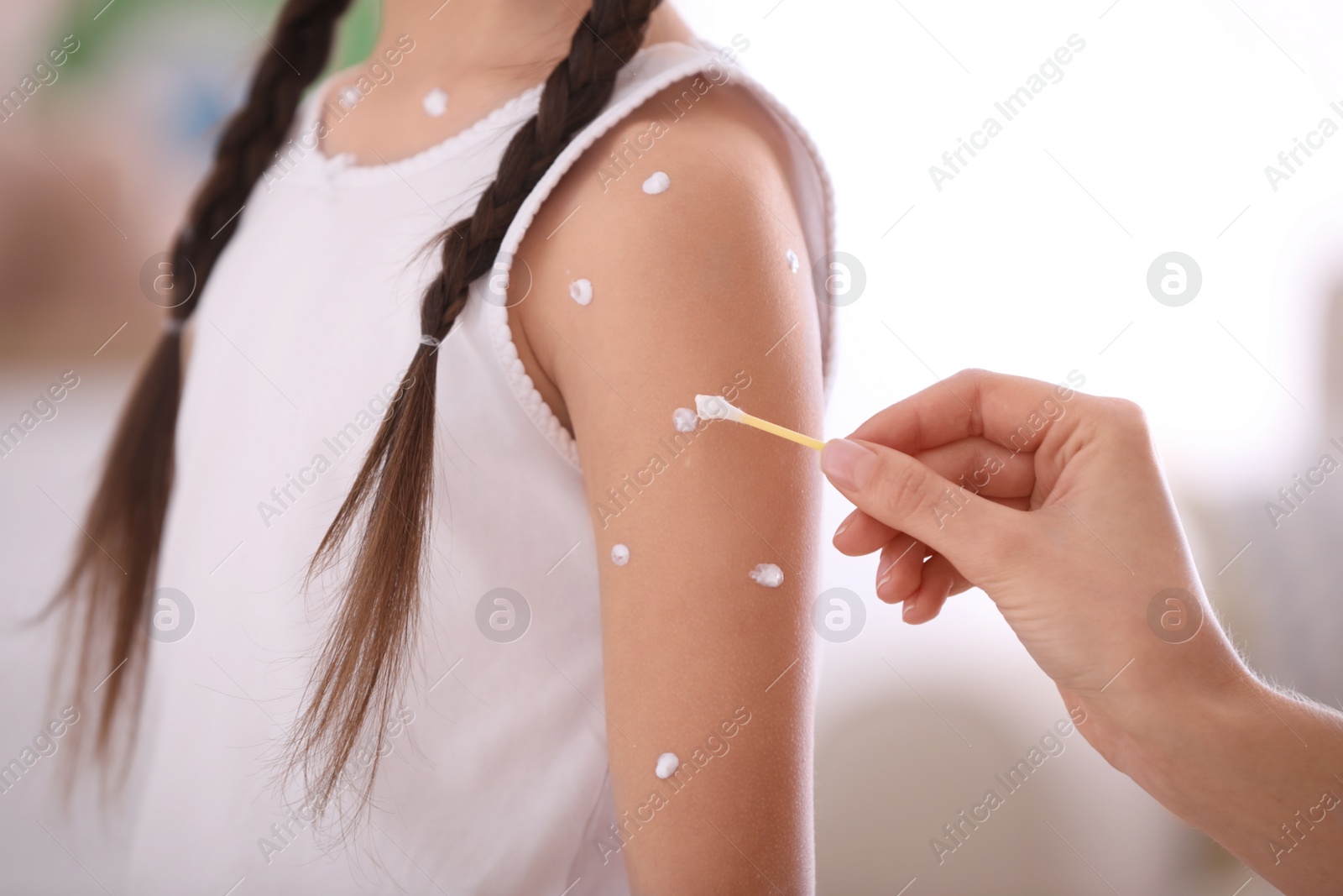 Photo of Mother applying cream onto skin of her daughter with chickenpox at home, closeup