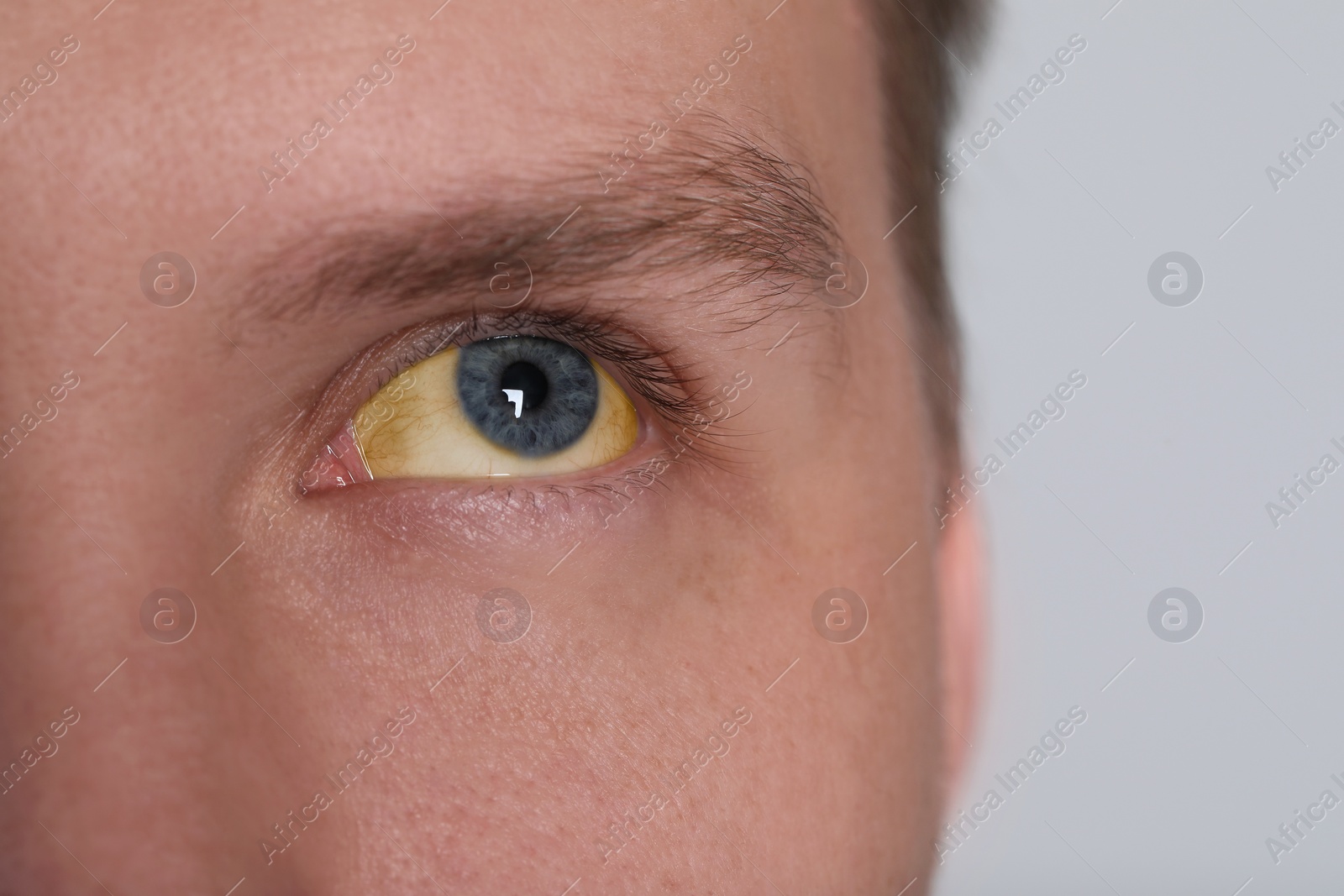 Photo of Man with yellow eyes on light background, closeup. Symptom of hepatitis