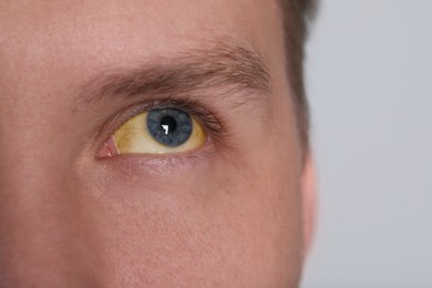 Photo of Man with yellow eyes on light background, closeup. Symptom of hepatitis