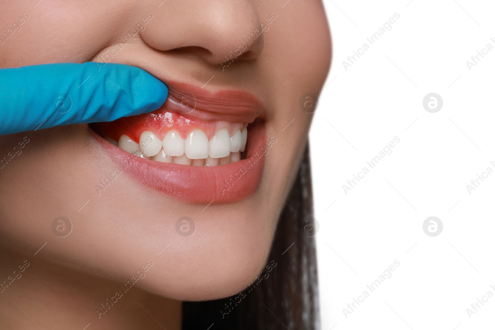 Image of Doctor examining woman's inflamed gum on white background, closeup