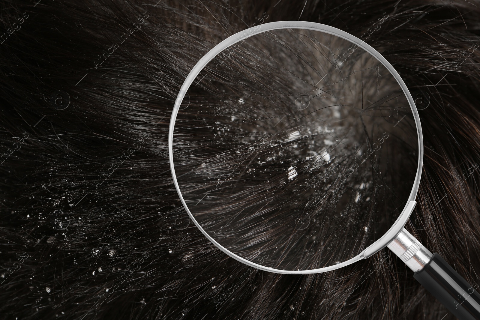 Image of Man suffering from dandruff, closeup. View through magnifying glass on hair with flakes