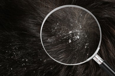 Man suffering from dandruff, closeup. View through magnifying glass on hair with flakes