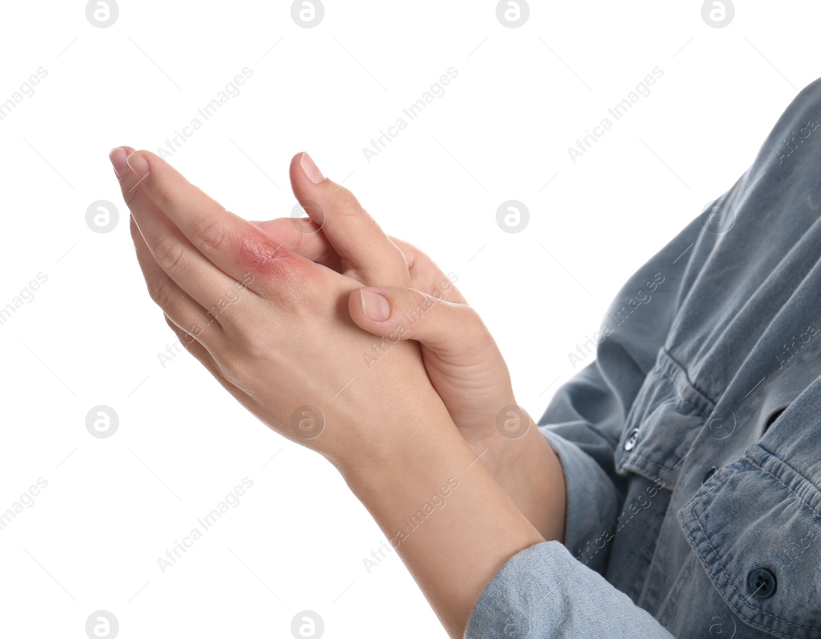 Photo of Woman with burn of her hand on white background, closeup