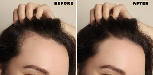 Image of Woman suffering from baldness on beige background, closeup. Collage with photos before and after treatment