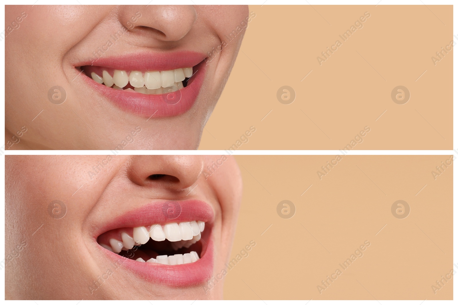 Image of Woman showing teeth before and after whitening on beige background, collage