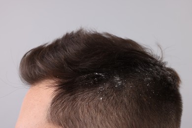 Man with dandruff in his dark hair on light grey background, closeup