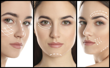 Image of Photos of young woman with lifting marks on face against white background, collage. Cosmetic surgery