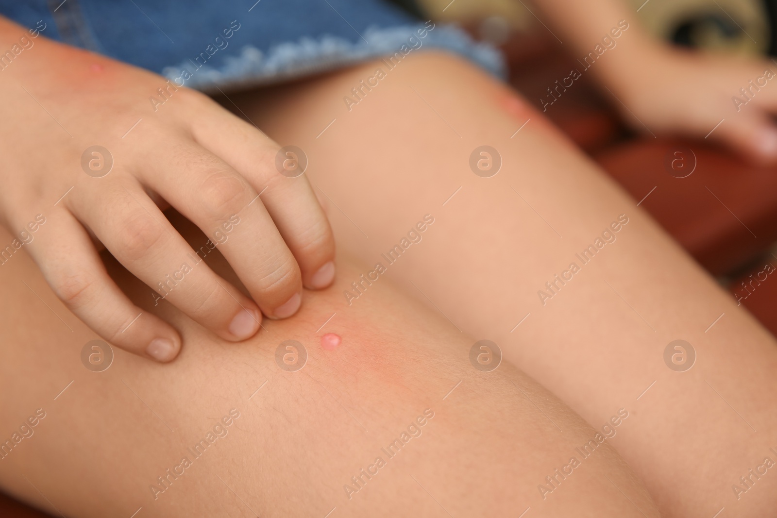 Photo of Girl scratching leg with insect bite outdoors, closeup