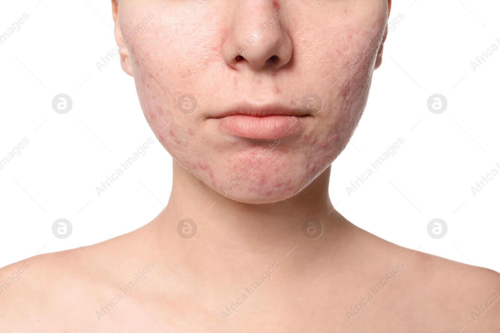 Photo of Young woman with acne problem on white background