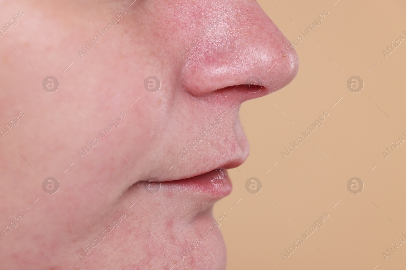 Photo of Closeup view of woman with blackheads on her nose against beige background, space for text