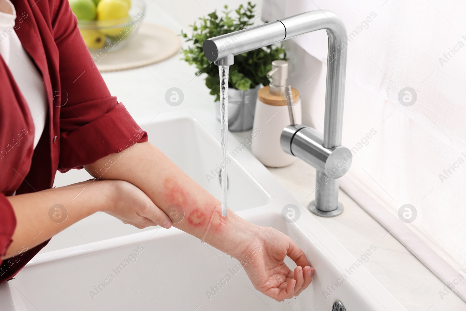 Photo of Woman putting hand with burns under cold running water indoors, closeup