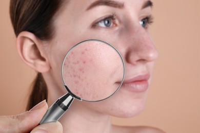 Dermatologist looking at woman's face with magnifying glass on beige background, closeup. Zoomed view on acne
