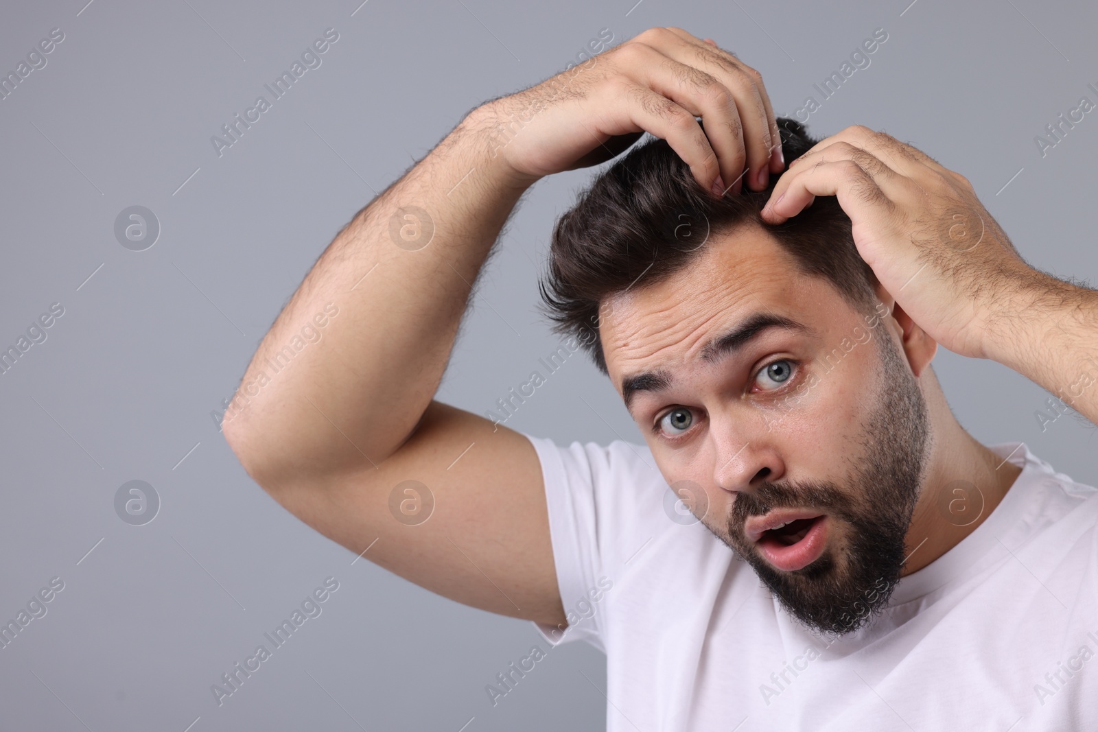 Photo of Emotional man examining his head on light grey background. Dandruff problem