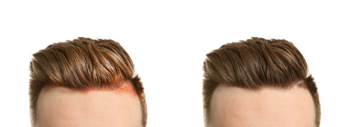Man before and after hair treatment with high frequency darsonval device on white background, closeup. Collage of photos