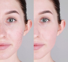 Image of Acne problem. Young woman before and after treatment on grey background, collage of photos