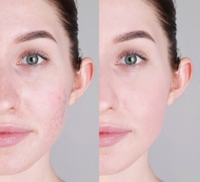 Acne problem. Young woman before and after treatment on grey background, collage of photos