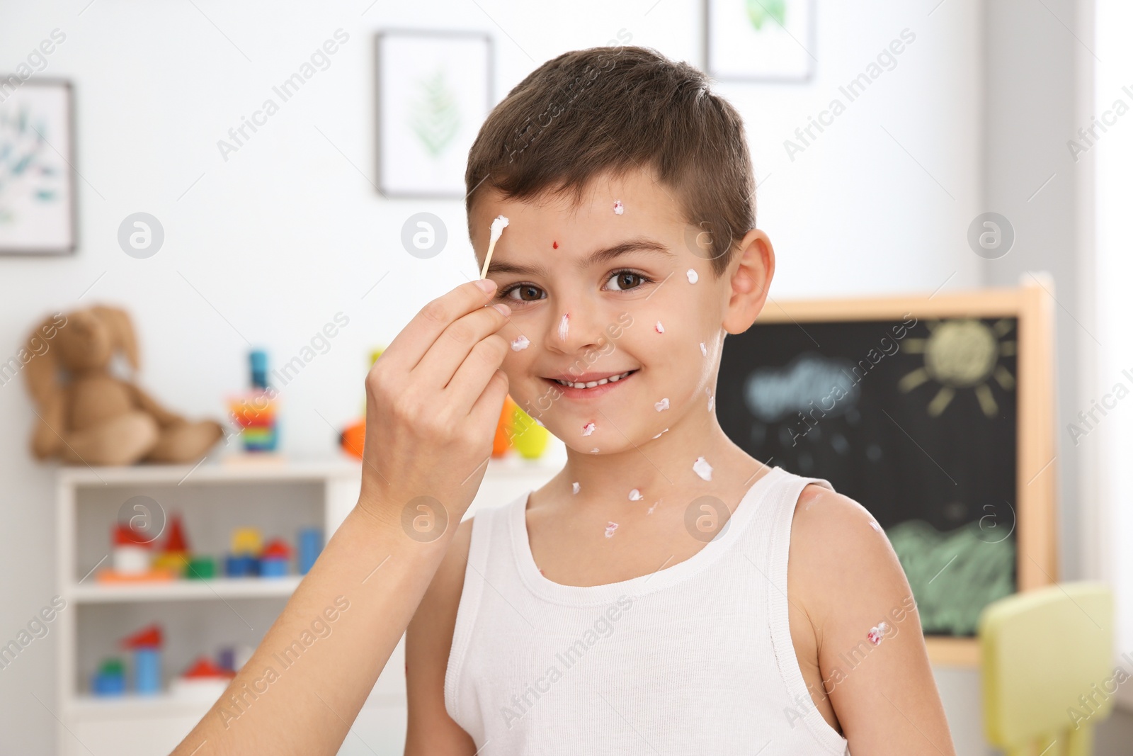 Photo of Woman applying cream onto skin of little boy with chickenpox at home