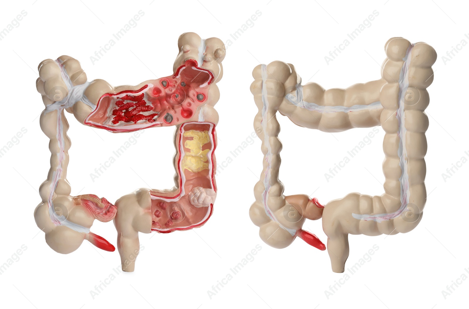 Image of Anatomical model of large intestine on white background, collage. Gastroenterology