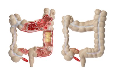 Image of Anatomical model of large intestine on white background, collage. Gastroenterology