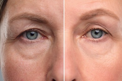 Image of Aging skin changes. Collage with photos of mature woman before and after cosmetic procedure, closeup