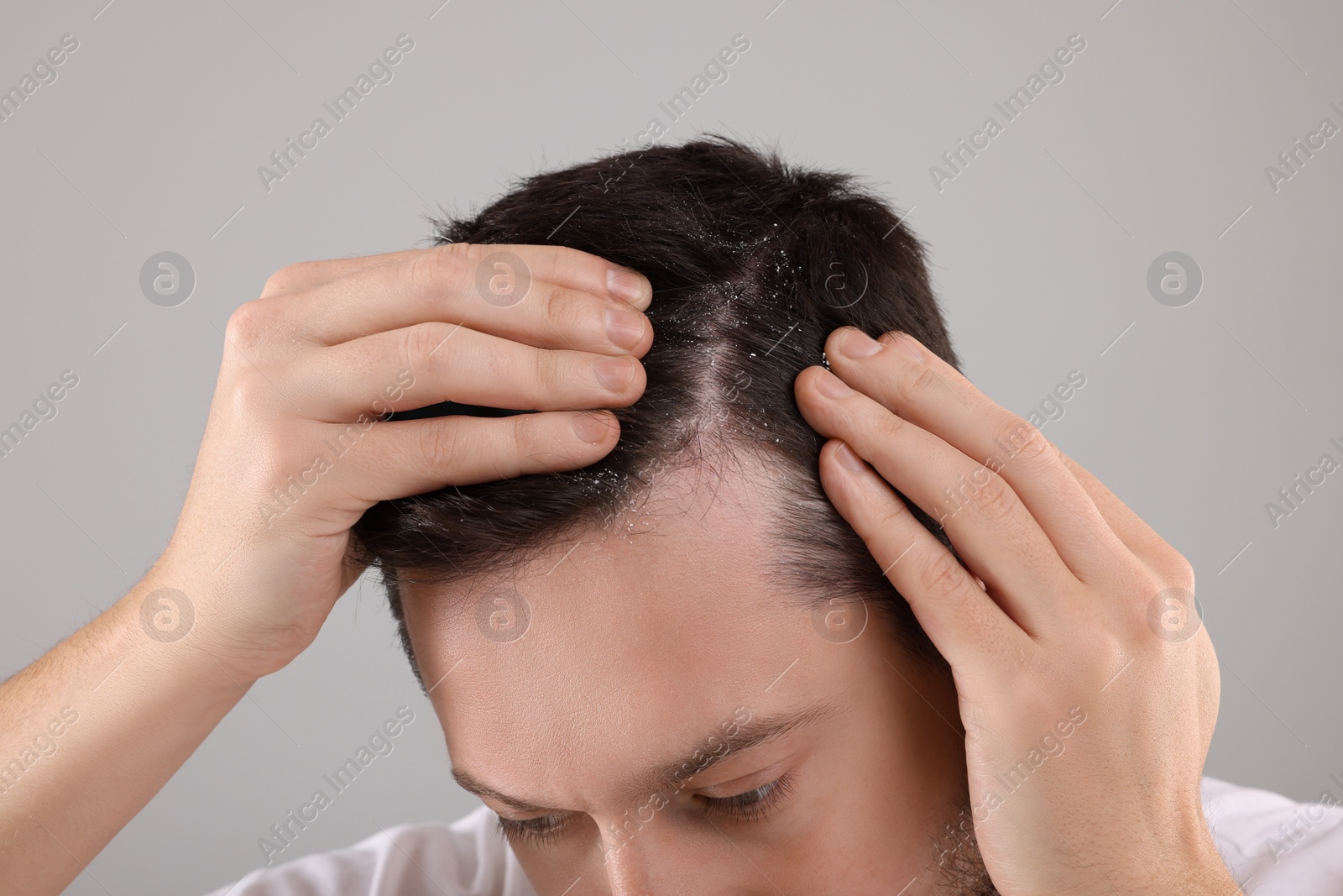 Photo of Man with dandruff in his dark hair on light gray background, closeup