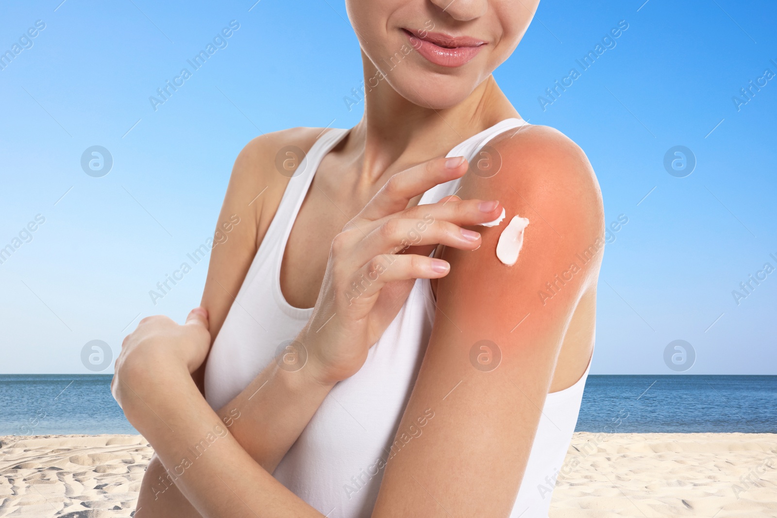 Image of Woman with sunburn on beach, closeup. Skin protection from sun in summer