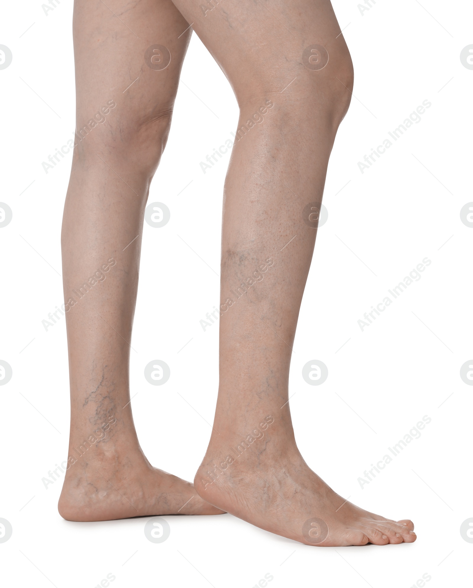 Photo of Closeup view of woman with varicose veins on white background