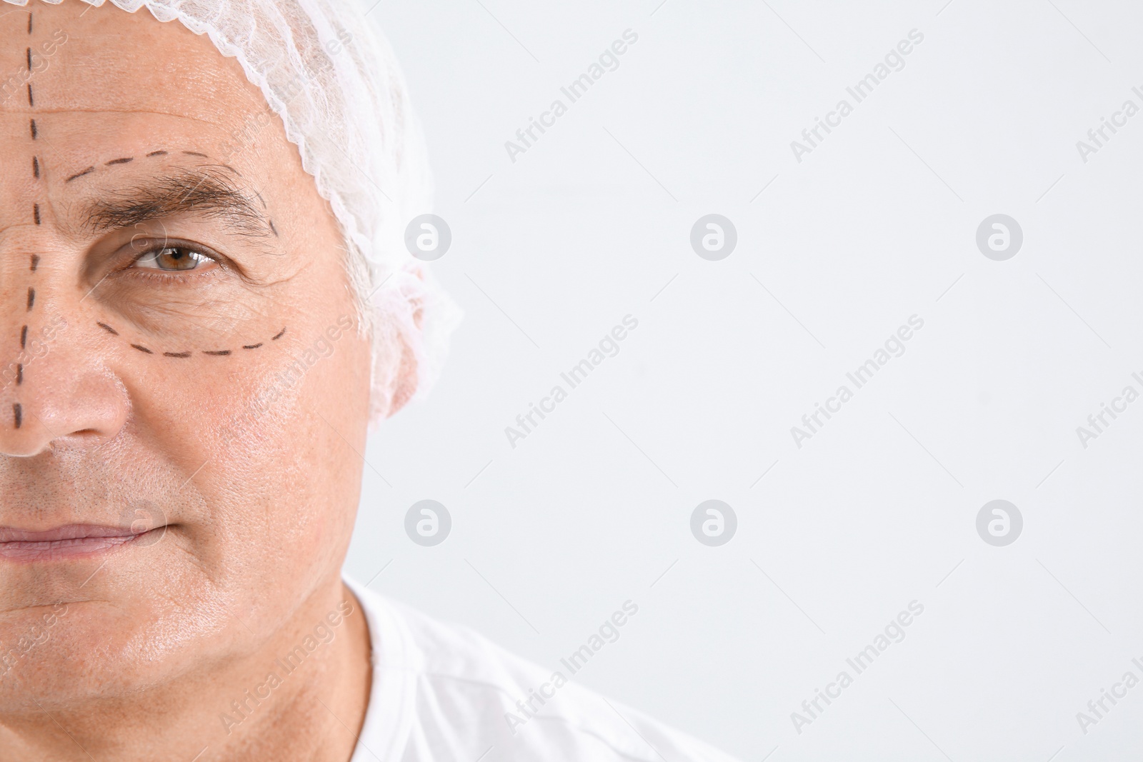 Photo of Senior man with marks on face preparing for cosmetic surgery against white background, closeup. Space for text