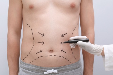 Photo of Doctor drawing lines on man's stomach with marker against light background