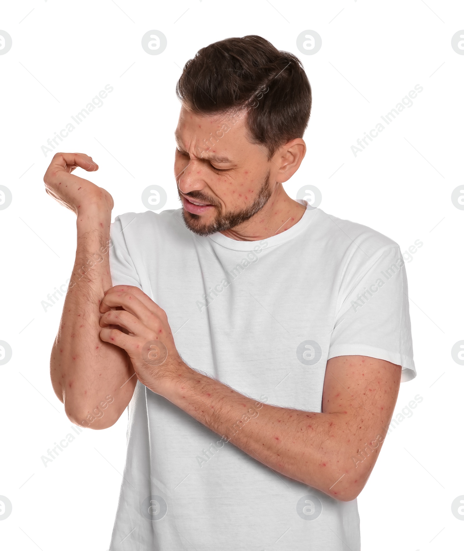 Photo of Man with rash suffering from monkeypox virus on white background