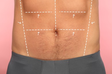 Image of Man with markings for cosmetic surgery on his abdomen against pink background, closeup