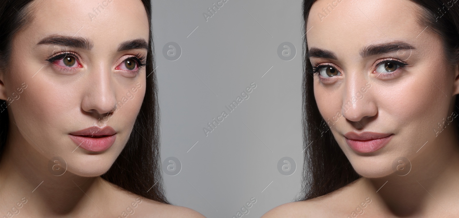 Image of Before and after conjunctivitis treatment. Photos of woman with red and healthy eyes, collage