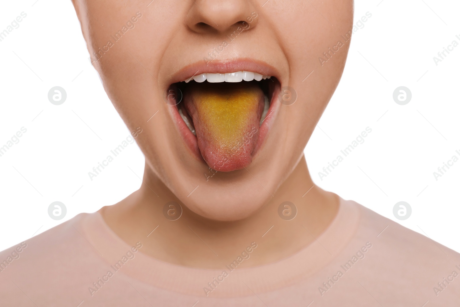 Photo of Gastrointestinal diseases. Woman showing her yellow tongue on white background, closeup