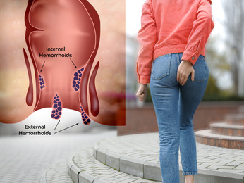 Woman suffering from hemorrhoid pain outdoors, back view. Illustration of unhealthy lower rectum